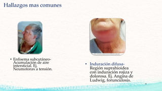 Hallazgos mas comunes
• Enfisema subcutáneo-
Acumulación de aire
intersticial. Ej.
Neumotorax a tensión.
• Induración difusa-
Región suprahioidea
con induración rojiza y
dolorosa. Ej. Angina de
Ludwig, forunculosis.
16
 