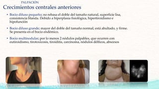 Crecimientos centrales anteriores
• Bocio difuso pequeño; no rebasa el doble del tamaño natural, superficie lisa,
consistencia blanda. Debido a hiperplasia fisiológica, hipertiroidismo e
hipofunción
• Bocio difuso grande; mayor del doble del tamaño normal, está abultado, y firme.
Se presenta en el bocio endémico.
• Bocio multinodular; por lo menos 2 nódulos palpables, que ocurren con
eutiroidismo, tirotoxicosis, tiroiditis, carcinoma, nódulos délficos, abscesos
PALPACIÓN
 