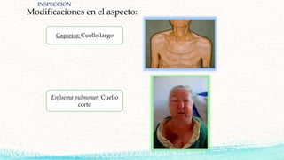 Modificaciones en el aspecto:
Caquexia: Cuello largo
Enfisema pulmonar: Cuello
corto
INSPECCION
 