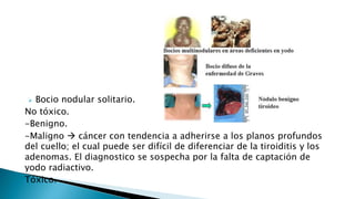  Bocio nodular solitario. 
No tóxico. 
-Benigno. 
-Maligno  cáncer con tendencia a adherirse a los planos profundos 
del cuello; el cual puede ser difícil de diferenciar de la tiroiditis y los 
adenomas. El diagnostico se sospecha por la falta de captación de 
yodo radiactivo. 
Tóxico. 
 