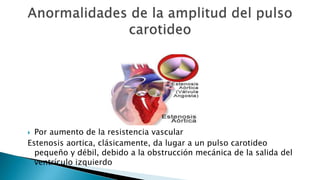  Por aumento de la resistencia vascular 
Estenosis aortica, clásicamente, da lugar a un pulso carotideo 
pequeño y débil, debido a la obstrucción mecánica de la salida del 
ventrículo izquierdo 
 