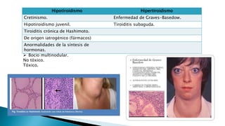 Hipotiroidismo Hipertiroidismo 
Cretinismo. Enfermedad de Graves-Basedow. 
Hipotiroidismo juvenil. Tiroiditis subaguda. 
Tiroiditis crónica de Hashimoto. 
De origen iatrogénico (fármacos) 
Anormalidades de la síntesis de 
hormonas. 
 Bocio multinodular. 
No tóxico. 
Tóxico. 
 