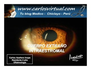 CUERPO EXTRAÑO
                 INTRAESTROMAL
Carlos Azañero Inope
  Residente 2 año
    Oftalmología
 