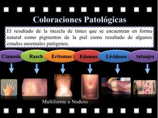 El resultado de la mezcla de tintes que se encuentran en forma
natural como pigmentos de la piel como resultado de algunos
estados anormales patógenos.
Cianosis Rasch Eritemas Edemas Livideses tatuajes
Multiforme o Nodoso
 