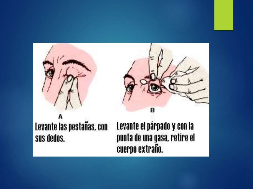 Primeros Auxilios en Cuerpos Extraños en Ojos, Nariz y Oídos Primeros Auxilios en Cuerpos Extraños en Ojos, Nariz y Oídos