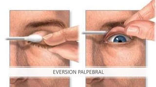 EVERSION PALPEBRAL
 