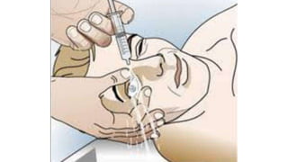 CUERPOS EXTRAÑOS 2023.pptx