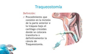 Traqueostomía
 