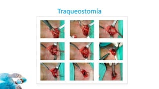 Traqueostomía
 