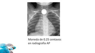 Moneda de 0.25 centavos
en radiografía AP
 
