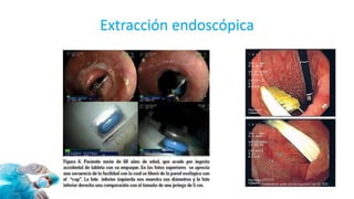 Extracción endoscópica
 