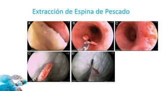 Extracción de Espina de Pescado
 