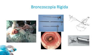 Broncoscopia Rígida
 