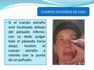 CUERPOS EXTRAÑOS EN OJOSSi puede ver el cuerpo extraño, trate de expulsarlo lavando el ojo; vierta el agua con una jeringa sin aguja, una jarra o bajo el grifo, inclinando la cabeza hacia el lado lesionado.