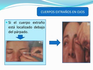 CUERPOS EXTRAÑOS EN OJOSSi no se obtienen  resultados y el cuerpo extraño  es móvil, pídale que parpadee, si logra localizarlo en el ángulo interno  usted puede retirarlo con la punta de un pañuelo limpio.