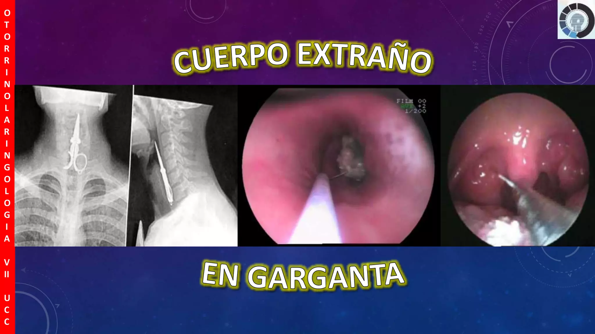 Cuerpos Extra os Nariz O do Faringe PPTX cuerpos-extra-os-nariz-o-do-faringe-pptx