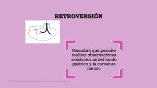 RETROVERSIÓN
Maniobra que permite
realizar observaciones
satisfactorias del fondo
gástrico y la curvatura
menor.
Córdoba Villalobos José Angel.Procedimientos endoscopicos en gastroenterología
 