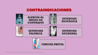 CONTRAINDICACIONES
ALERGIA AL
MEDIO DE
CONTRASTE
ESTENOSIS
ESOFÁGICA
ESTENOSIS
PILÓRICA
ESTENOSIS
DUODENAL
CIRUGÍA PREVIA
Córdoba Villalobos José Angel.Procedimientos endoscopicos en gastroenterología
 