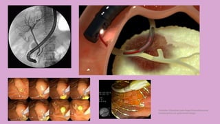 Córdoba Villalobos José Angel.Procedimientos
endoscopicos en gastroenterología
 