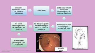 Paciente
recostado sobre
su costado
izquierdo
Tacto rectal
Lubricar porción
distal del
endoscopio y el
tubo de inserción
Introducción del
endoscopio a
través del ano
Se dirige la punta
del endoscopio
hacia la cicatriz
umbilical
La unión
rectosigmoidea
se localiza a los
15-20cm
Movimiento
paradójico (asa
colonica)
Ampolla
rectalCórdoba Villalobos José Angel.Procedimientos endoscopicos en
gastroenterología
 