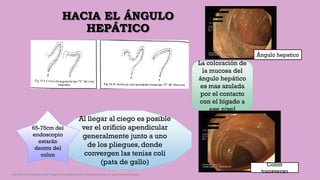 HACIA EL ÁNGULO
HEPÁTICO
La coloración de
la mucosa del
ángulo hepático
es mas azulada
por el contacto
con el hígado a
ese nivel
Al llegar al ciego es posible
ver el orificio apendicular
generalmente junto a uno
de los pliegues, donde
convergen las tenias coli
(pata de gallo)
65-75cm del
endoscopio
estarán
dentro del
colon
Colon
transverso
Ángulo hepatico
Córdoba Villalobos José Angel.Procedimientos endoscopicos en gastroenterología
 