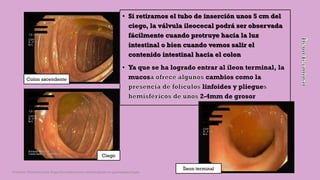 • Si retiramos el tubo de inserción unos 5 cm del
ciego, la válvula ileocecal podrá ser observada
fácilmente cuando protruye hacia la luz
intestinal o bien cuando vemos salir el
contenido intestinal hacia el colon
• Ya que se ha logrado entrar al íleon terminal, la
mucos cambios como la
linfoides y pliegue
2-4mm de grosor
Colon ascendente
Ciego
Íleon terminal
Córdoba Villalobos José Angel.Procedimientos endoscopicos en gastroenterología
 
