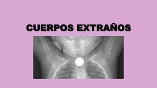 CUERPOS EXTRAÑOS
 