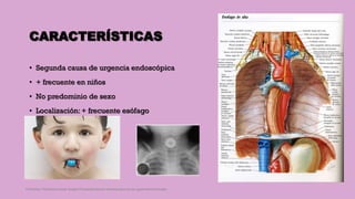 CARACTERÍSTICAS
• Segunda causa de urgencia endoscópica
• + frecuente en niños
• No predominio de sexo
• Localización: + frecuente esófago
Córdoba Villalobos José Angel.Procedimientos endoscopicos en gastroenterología
 