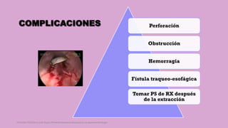COMPLICACIONES Perforación
Obstrucción
Hemorragia
Fístula traqueo-esofágica
Tomar PS de RX después
de la extracción
Córdoba Villalobos José Angel.Procedimientos endoscopicos en gastroenterología
 