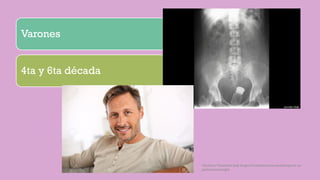 Varones
4ta y 6ta década
Córdoba Villalobos José Angel.Procedimientos endoscopicos en
gastroenterología
 