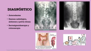 DIAGNÓSTICO
• Antecedentes
• Examen radiológico,
abdomen y pelvis (tórax)
• Rectosigmoidoscopia y
colonoscopia
Córdoba Villalobos José Angel.Procedimientos endoscopicos en gastroenterología
 