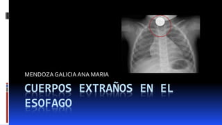 CUERPOS EXTRAÑOS EN EL
ESOFAGO
MENDOZAGALICIAANA MARIA
 