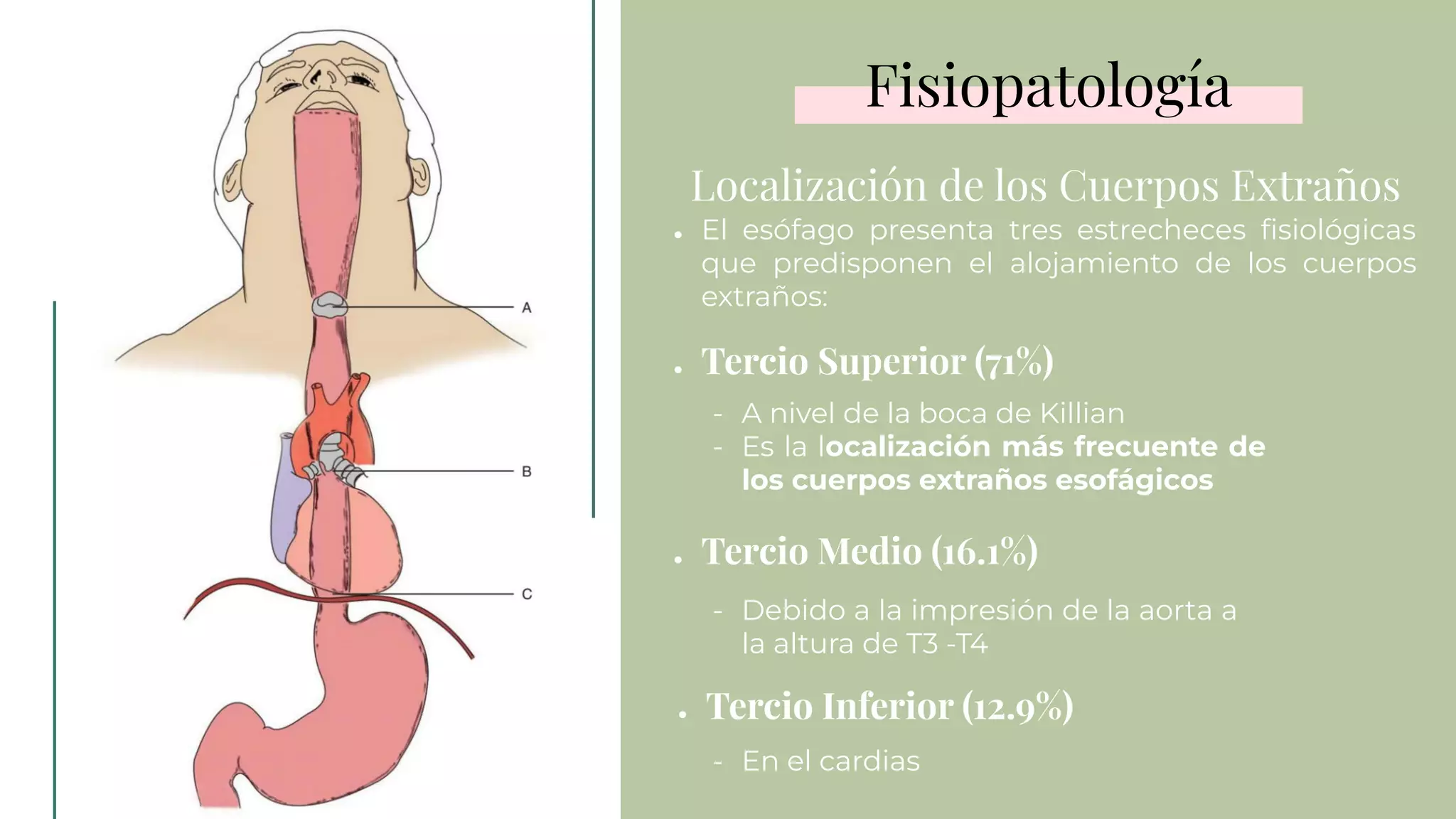 CUERPOS EXTRAÑOS EN ESÓFAGO