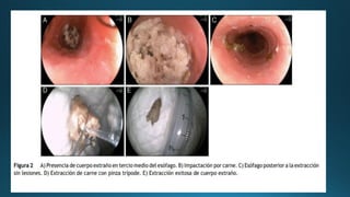CUERPOS EXTRAÑOS EN ESOFAGO para estudiantespdf