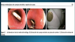 CUERPOS EXTRAÑOS EN ESOFAGO para estudiantespdf