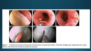 CUERPOS EXTRAÑOS EN ESOFAGO para estudiantespdf