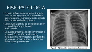 CUERPOS EXTRAÑOS EN ESOFAGO para estudiantespdf