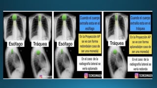 CUERPOS EXTRAÑOS EN ESOFAGO para estudiantespdf