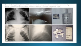 CUERPOS EXTRAÑOS EN ESOFAGO para estudiantespdf