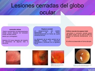 Lesiones cerradas del globo
ocular
commotio retinae
Patrón característico de blanqueamiento
retinal, ocurre después de contusión
ocular cerrada intensa.
(lesión por contragolpe).
Aparece 24 horas después del impacto
se desvanece de algunos días a
semanas.
Ruptura coroidal
un desgarramiento del epitelio
pigmentado de la retina,
característicamente en forma de cuarto
creciente de luna.
La afectación de la parte central de la
mácula, resulta en reducción
permanente y profunda de la agudeza
visual.
Orificio macular de espesor total
secundario a contusión cerrada grave
del globo ocular, en el cual la onda de
choque se transmite directamente a la
fóvea.
El orificio se desarrolla en forma abrupta,
 