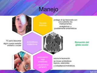 Manejo
Toxoide
tetánico
protege al ojo lesionado con
una cubierta; los
medicamentos
analgésicos, y
posiblemente antieméticos
antibióticos
sistémicos
TC para descartar
algún cuerpo extraño
orbitario u ocular
exploración
bajo
anestesia
(usualmente
general).
sutura la laceración
se inician antibióticos
tópicos, esteroides
y ciclopléjicos/midriáticos.
Remoción del
globo ocular
 