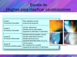 Escala de
Hughes para clasificar causticaciones
 