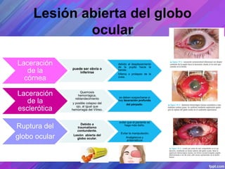 Lesión abierta del globo
ocular
Laceración
de la
córnea
puede ser obvia o
inferirse
debido al desplazamiento
de la pupila hacia la
herida.
hifema o prolapso de la
úvea.
Laceración
de la
esclerótica
Quemosis
hemorrágica,
reblandecimiento
y posible colapso del
ojo, al igual que
hemorragia del Vítreo.
se deben sospecharse si
hay laceración profunda
del párpado.
Ruptura del
globo ocular
Debido a
traumatismo
contundente.
Lesión abierta del
globo ocular.
evitar que el paciente se
haga más daño.
Evitar la manipulación.
Analgésicos y
antieméticos
 