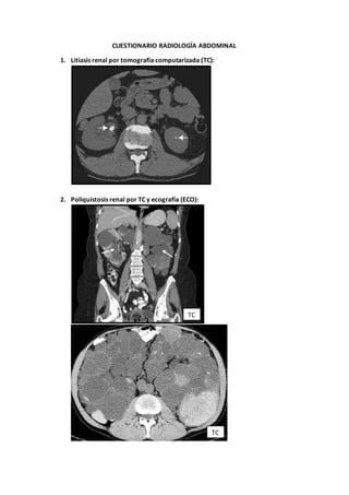 CUESTIONARIO RADIOLOGÍA ABDOMINAL
1. Litiasis renal por tomografía computarizada (TC):
2. Poliquistosis renal por TC y ecografía (ECO):
TC
TC
 