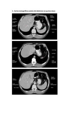1-. Cortes tomográficos axiales del abdomen en puntos clave:
 