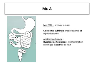 Mr. A
Mai 2017 , premier temps :
Colectomie subtotale avec iléostomie et
sigmoïdostomie
Anatomopathologie :
Dysplasie de haut grade et inflammation
chronique évocatrice de RCH
 