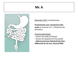 Mr. A
Décembre 2017, second temps :
Proctectomie avec anastomose iléo-
anale et réservoir en J + iléostomie de
dérivation
Anatomopathologie :
- Lésions de colite chronique
- Lésions de dysplasie de haut grade
- Adénocarcinome lieberkuhnien bien
différencié de 10 mm, classé pT2N0
 