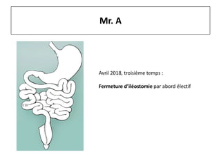 Mr. A
Avril 2018, troisième temps :
Fermeture d’iléostomie par abord électif
 