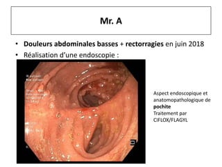 • Douleurs abdominales basses + rectorragies en juin 2018
• Réalisation d’une endoscopie :
Mr. A
Aspect endoscopique et
anatomopathologique de
pochite
Traitement par
CIFLOX/FLAGYL
 