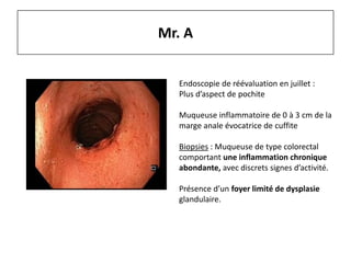 Mr. A
Endoscopie de réévaluation en juillet :
Plus d’aspect de pochite
Muqueuse inflammatoire de 0 à 3 cm de la
marge anale évocatrice de cuffite
Biopsies : Muqueuse de type colorectal
comportant une inflammation chronique
abondante, avec discrets signes d’activité.
Présence d’un foyer limité de dysplasie
glandulaire.
 